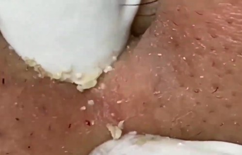 挤痘痘(挤痘痘颅内感染前兆)