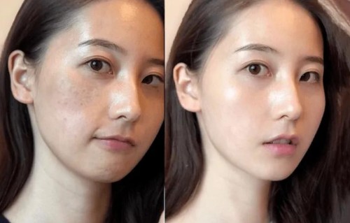 祛斑哪里好(安康祛斑哪里好)