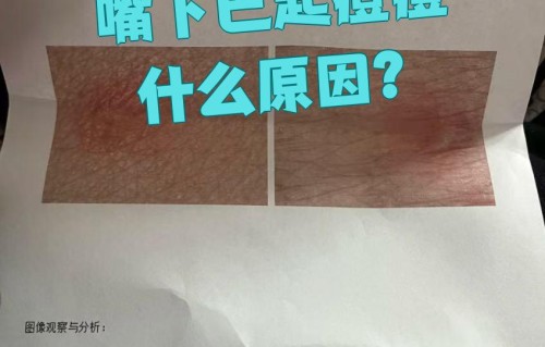 嘴下巴长痘痘怎么回事(嘴下巴长痘痘怎么回事吃什么)