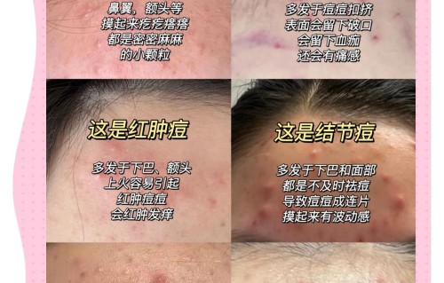 脸上长痘痘怎么调理(青春期脸上长痘痘怎么调理)
