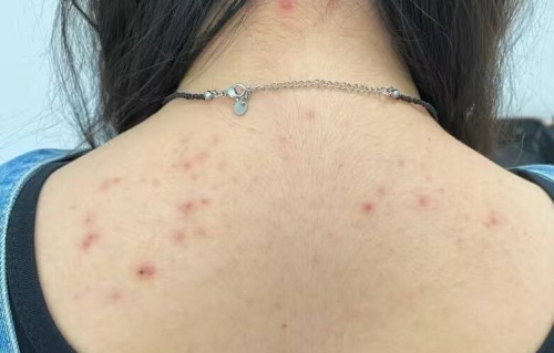 后背痘痘(后背痘痘多怎么回事)
