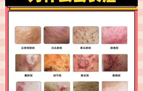 长痘痘是什么原因(私处长痘痘是什么原因)