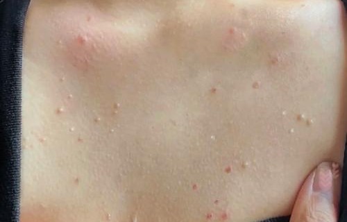 胸前长痘痘怎么回事(男的胸前长痘痘怎么回事)