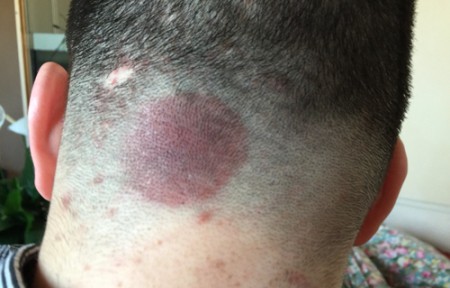 后脑勺长痘痘怎么回事(后脑勺长痘痘怎么回事?)