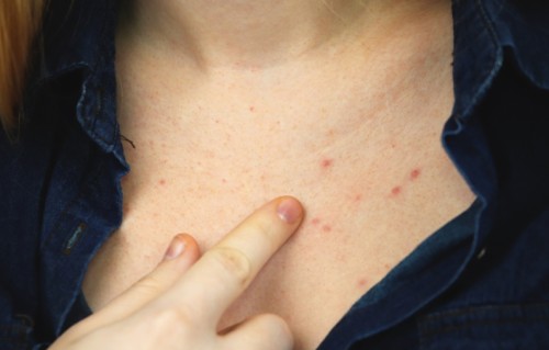 胸前长痘痘(胸前长痘痘一直不消怎么办)