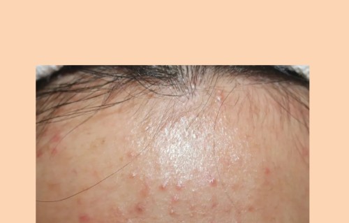 眉毛中间长痘痘是什么原因(眉头之间长痘痘什么原因)