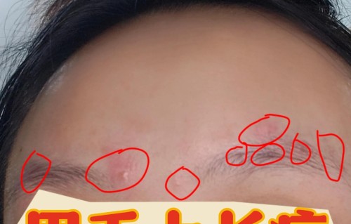 眉毛上长痘痘是什么原因(为什么眉毛上面会长痘痘)