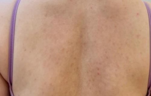 血热长痘痘怎么调理(血热长痘痘怎么调理用什么外用药好)