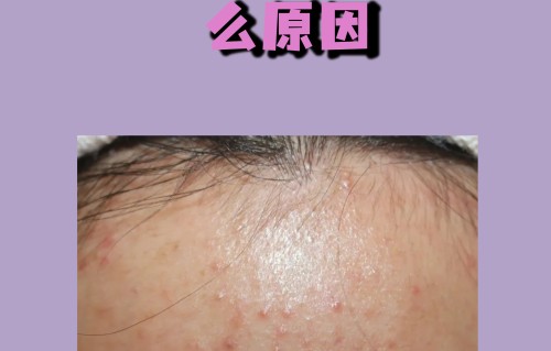 脸上长痘痘了(脸上长痘痘了擦什么药效果好)