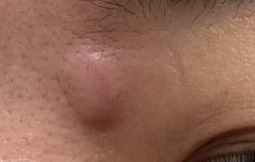 痘痘变成硬硬的鼓包怎么去除(痘痘增生性疤痕凸起怎么去除)