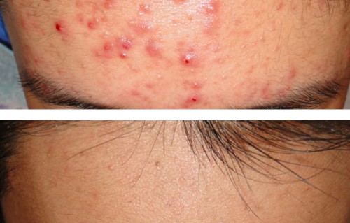 额头长痘痘(额头长痘痘怎么才能消除)