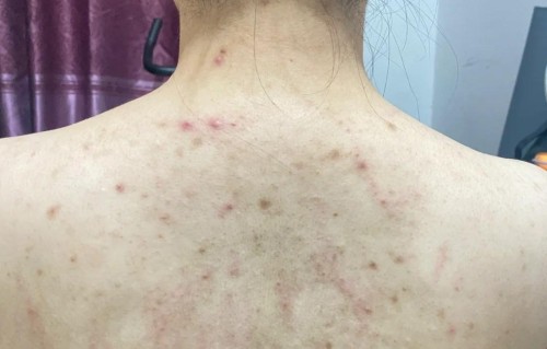 身上长痘痘(身上长痘痘还带有脓包是什么原因)