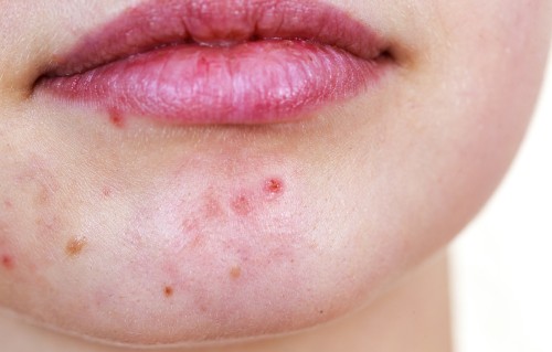 嘴角长痘痘(嘴角长痘痘吃什么食物好得快)