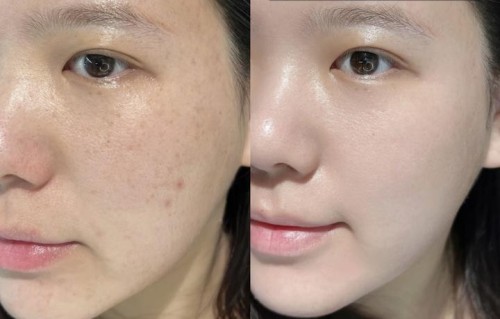 激光祛斑多少钱(c10激光祛斑多少钱)