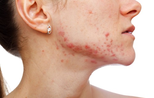 内分泌失调老长痘痘(内分泌失调老长痘痘挂什么科)