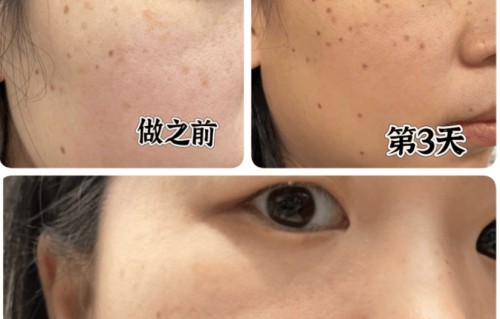 激光祛斑疼不疼(激光祛斑疼不疼几天才能好)