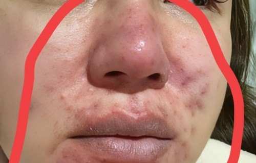 痘痘(痘痘的类型分为哪几种)