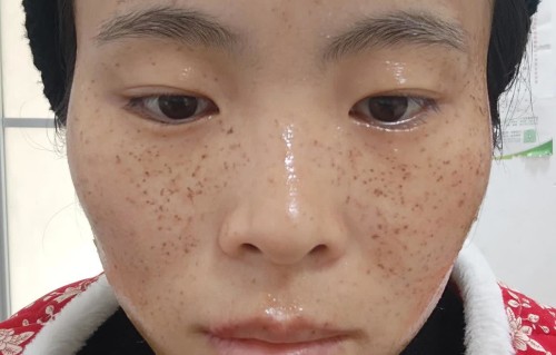 激光祛斑(激光祛斑后的保养和注意事项)