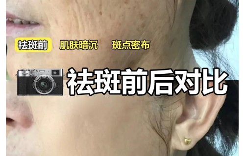 祛老年斑小妙招(祛老年斑小妙招图片)