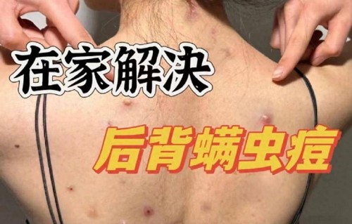 后背长痘痘是什么原因引起的(后背长痘痘是怎么消除)