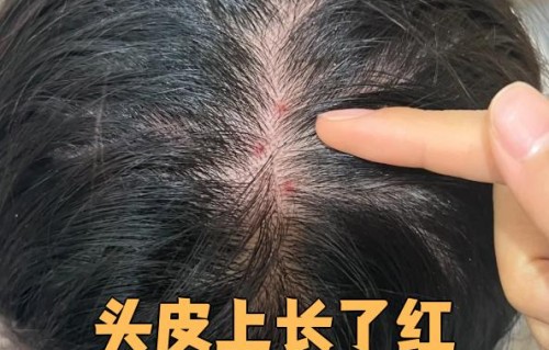 头皮痘痘(头皮痘痘结痂又抠掉又结痂怎么治)