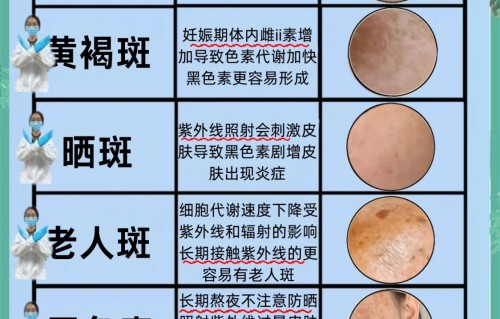 祛斑多少钱(祛斑多少钱一次?)