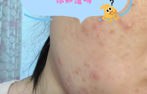 脸颊两侧长痘痘什么原因(男生脸颊两侧长痘痘什么原因)