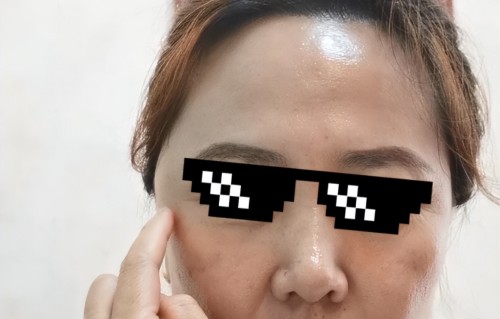 太阳穴长痘痘(太阳两侧长痘痘是什么原因是什么)