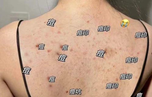 后背长痘痘怎么回事(男孩前胸后背长痘痘怎么回事)