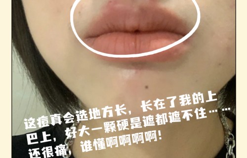 人中长痘痘是什么原因(人中反复长痘痘是什么原因)