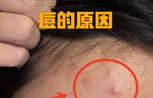 额头上长痘痘是什么原因(45岁额头上长痘痘是什么原因)