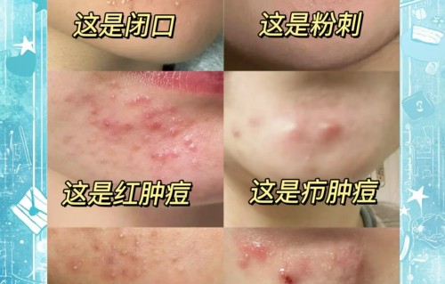 下巴长痘痘红肿硬硬的还疼怎么解决(突然下巴长痘痘红肿硬硬的还疼怎么解决)