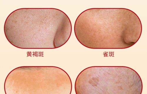 美白祛斑方法(美白祛斑超简单方法)