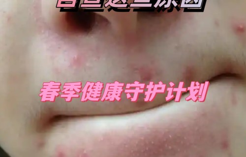 嘴角长痘痘是什么原因(经期嘴角长痘痘是什么原因)