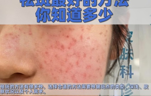 祛痘祛斑(祛痘祛斑印激光)