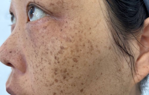 医院皮肤科可以祛斑吗(医院皮肤科能治疗脸上的斑吗)