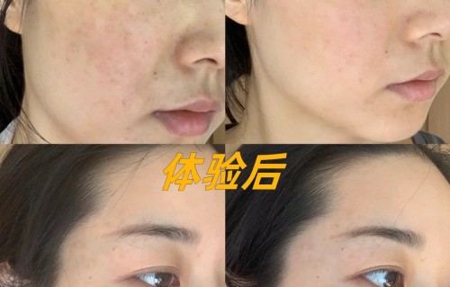 皮秒祛斑效果怎么样(秒皮祛斑怎么样会反弹吗)