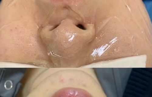 光子嫩肤可以祛斑吗(光子嫩肤可以祛斑吗?)