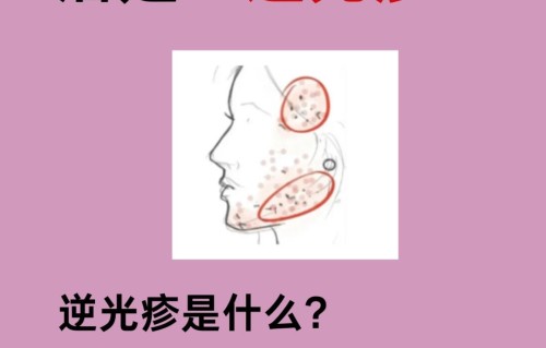 太阳穴长痘痘是什么原因(太阳两侧长痘痘是什么原因是什么)