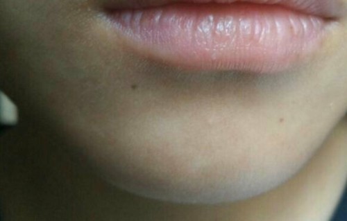 嘴上长痘痘(同房之后嘴上长痘痘)
