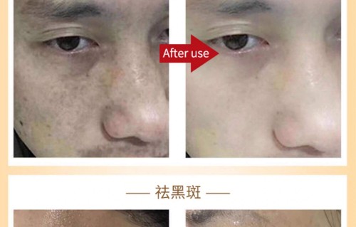 快速祛斑美白(快速祛斑美白的方法)