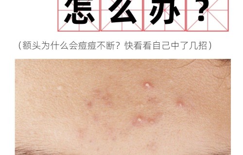 额头长痘痘怎么办(十二岁女生额头长痘痘怎么办)