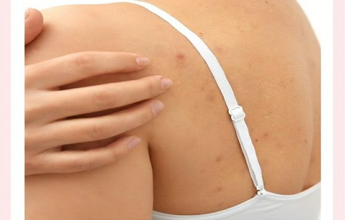 后背长痘痘怎么办(高中生前胸后背长痘痘怎么办)