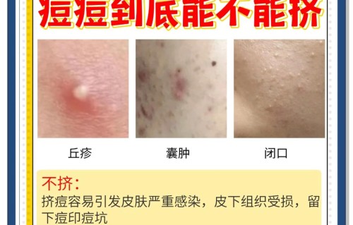 祛除痘痘的有效方法(老年斑消除最好的方法)