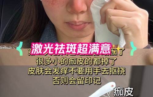 激光祛斑一次多少钱(激光祛斑一次多少钱能维持多久能彻底去掉吗)