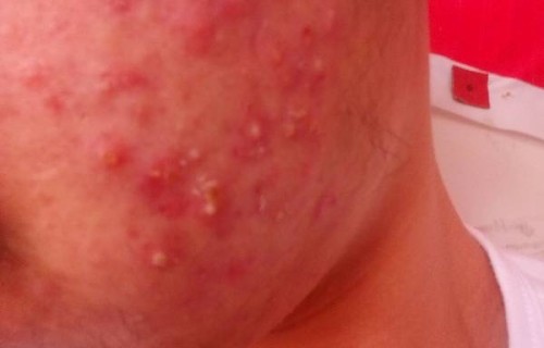 胸口有红色的小痘痘(胸口有红色的小痘痘可用什么药膏)