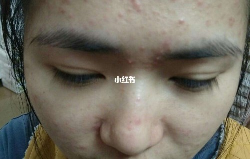丘疹型痘痘(丘疹型痘痘用什么药膏最有效)