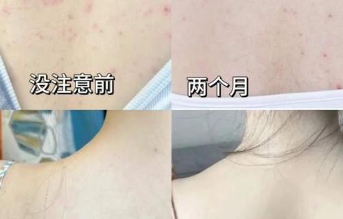 背部长痘痘是什么原因(脸部和背部长痘痘是什么原因)