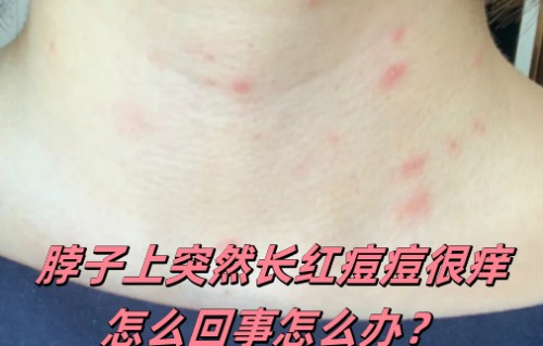 脖子上长痘痘什么原因(脖子上长痘痘什么原因长春肤康在哪)