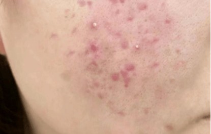 痘痘已经平了一直红着(痘痘已经平了一直红着可以吃消炎药吗)